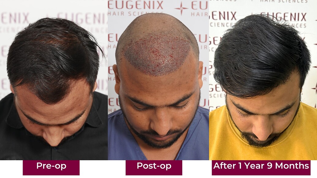 https://cdn.forumhairtransplant.com/optimized/3X/2/8/28254461c46c45ae4e53a3f0d89cd70e22acfb57_2_1035x582.jpeg