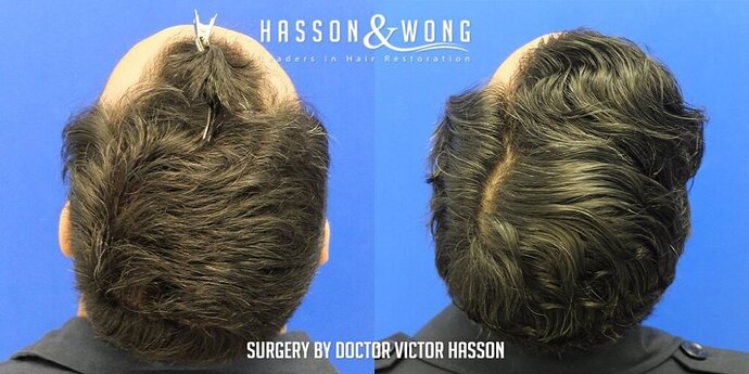 Dr. Hasson / 2,500 grafts / FUE / Hairline / 1 Year Post-op photo