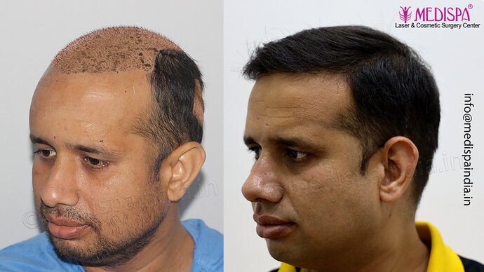 Dr. Suneet Soni - 4500 Grafts, Combine FUT + FUE Technique, NW-III photo