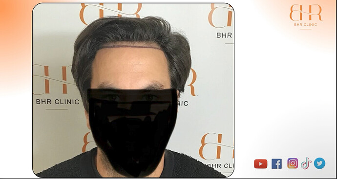 Dr. Bisanga and Dr. Kostis BHR Clinic - 2410 FUE 0 - 12 Months With Video photo
