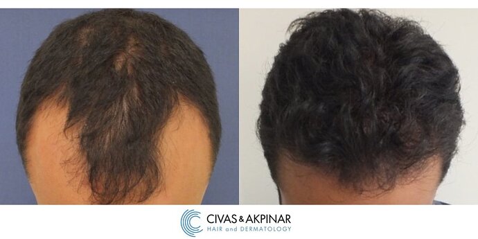 Civas&Akpınar Hair Transplant- FUE Hair Transplant Before & After Pictures (3100 Grafts) photo