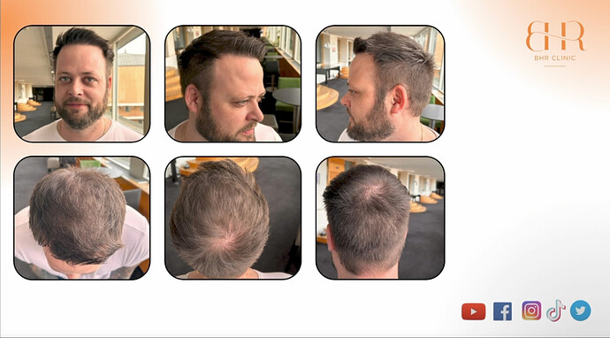 Dr. Bisanga and Dr. Kostis BHR Clinic - MEGA-Sessions FUE/Body Hair Repair Patient - 9917 Grafts NW6 - Full coverage! Patient video included! photo