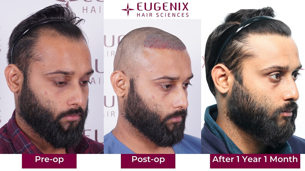 https://cdn.forumhairtransplant.com/optimized/3X/2/9/295c91253ff88c7eab01dea6a6a93685449f4d2c_2_1035x582.jpeg