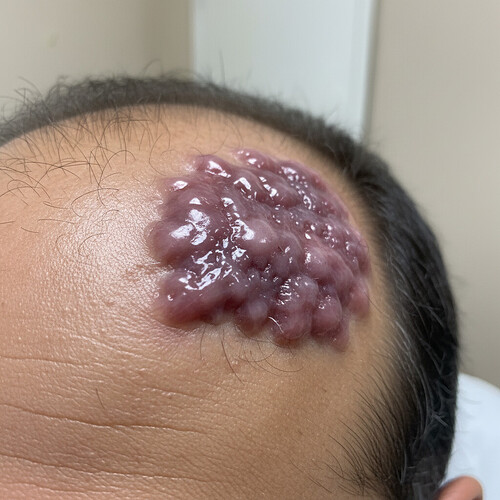 Illustration of a keloid scar on a scalp