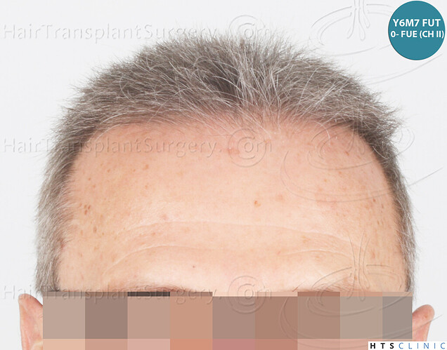 Dr Devroye + Dr Montesanti + Dr Jenard / 7015 grafts (4512 FUT + 2503 FUE) / 2 sessions photo