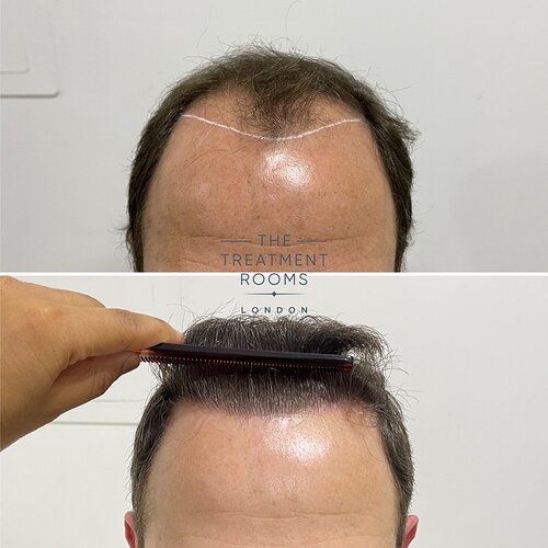 2078 Grafts FUE Hair Transplant Hairline- The Treatment Rooms London photo