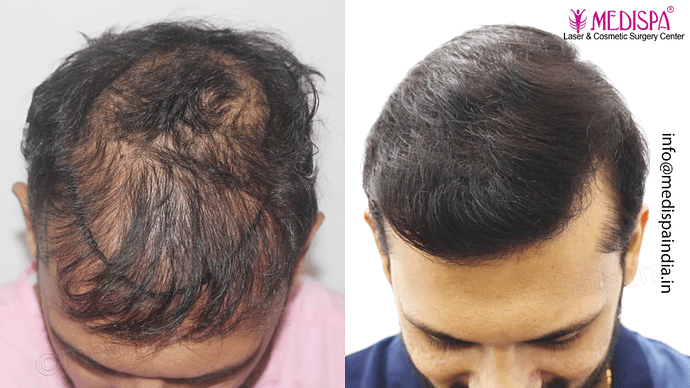 Dr. Suneet Soni - 4665 Grafts, Combine FUT + FUE + BHT (Beard) Technique photo