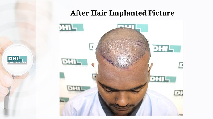 DHI India | NW 4 | 2,354 Grafts | 7-Months DHI Hair Transplant Results photo