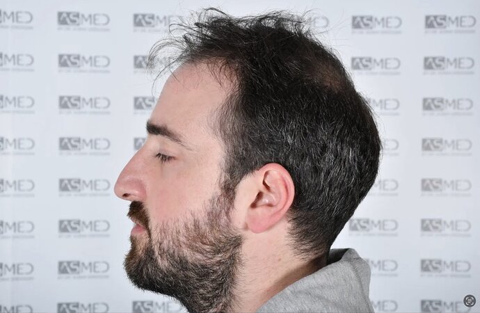 ASMED CLINIC CASE - DR.KORAY 5000 GRAFTS FUE photo