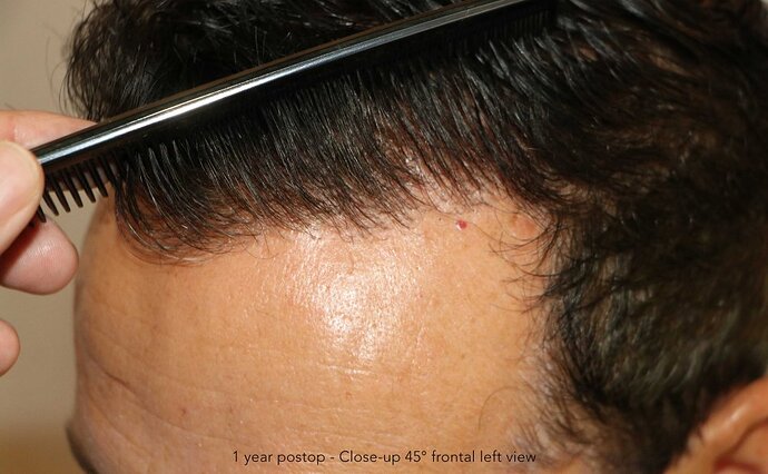 Case performed by Dr. Feriduni – 3095 FU in 1 procedure photo