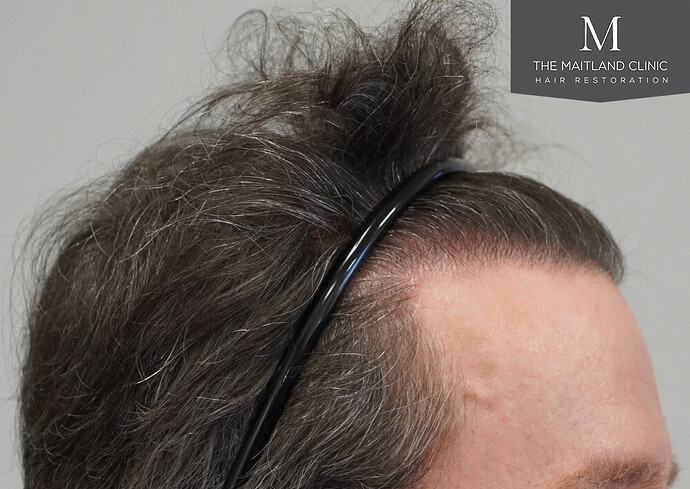 Before and after results: 1694 grafts by FUE at The Maitland Clinic (Dr Edward Maitland Ball) photo