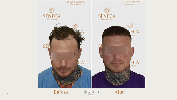 Seneca Medical Group - 1556 grafts with Direct FUE photo