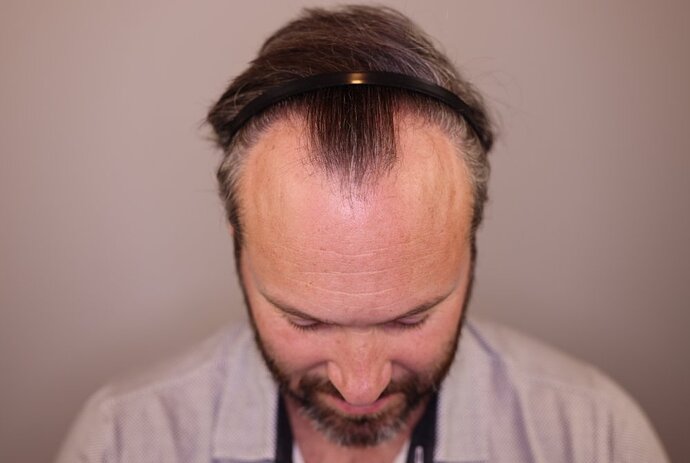 Utah Hair Restoration - Dr. Barton alviarmani photo