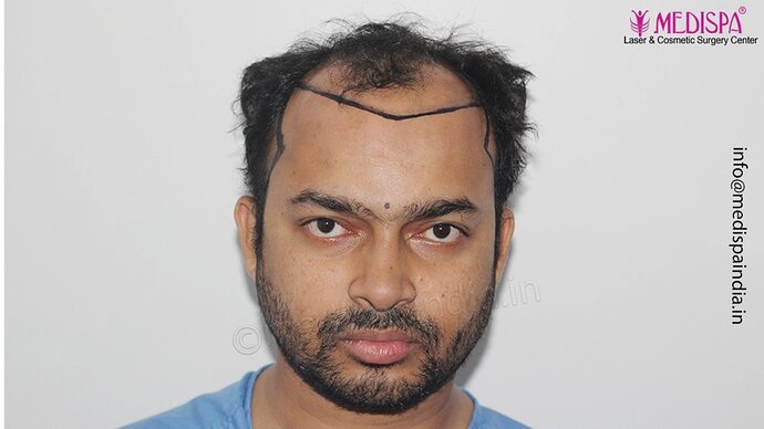 Dr. Suneet Soni - 5000 Grafts, Combine FUT + FUE + Beard Technique, NW-V photo