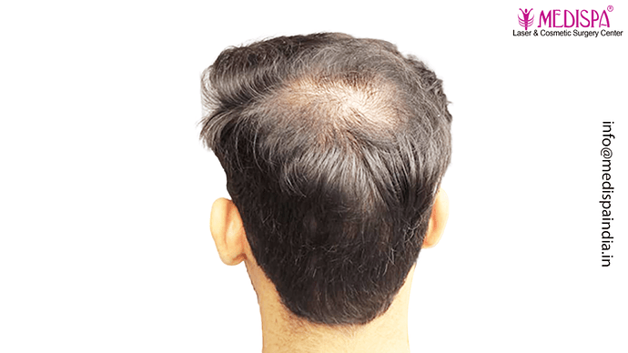 Dr. Suneet Soni - 4046 Grafts | 12-Month Result | Combination FUT + FUE + Beard photo