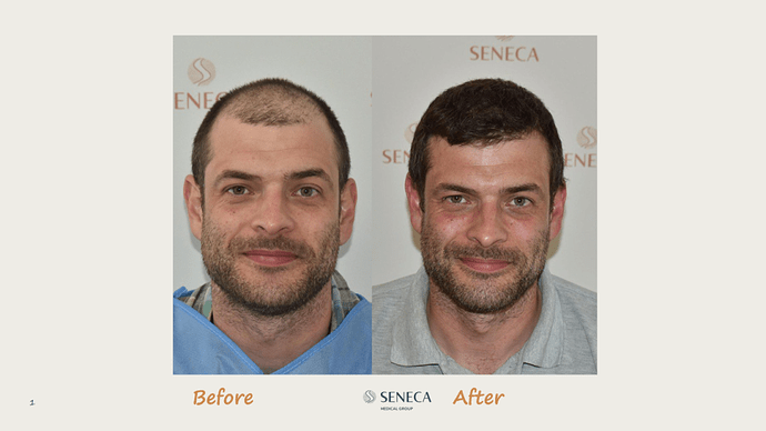 Seneca Medical Group - 2308 grafts with Direct Fue photo