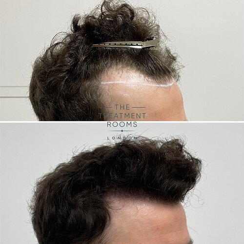 FUE Hairline Restoration 1306 Grafts- The Treatment Rooms London photo