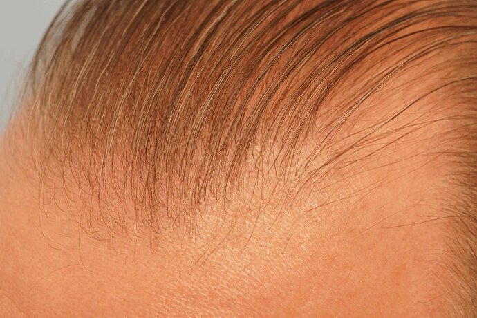 Dr B Farjo 1700g FUE (Front) photo