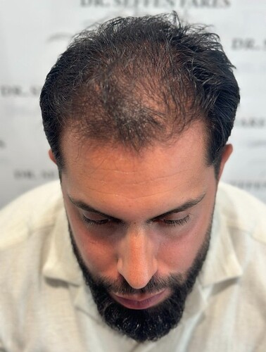 Dr Fares Seffen (Tunis, Tunisia) 3760 FUE results (Diffuse NW 4) Day 0 --> 10 Months after photo
