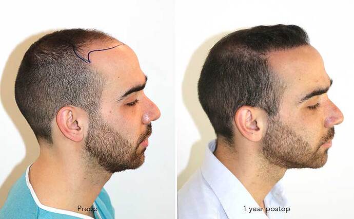 Case performed by Dr. Feriduni – 3505 FU in 1 procedure photo