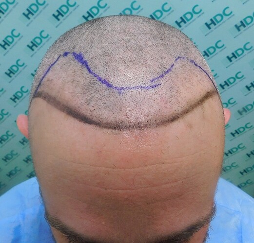 Result of Class 3V Patient – 3530 Grafts – HDC Hair clinic – Dr Maras photo