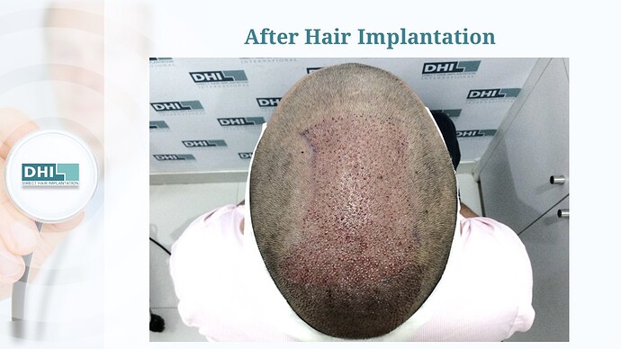 DHI India™ | Crowning Glory Restored | 2,650 Grafts | 8 Months Hair Transplant Result photo