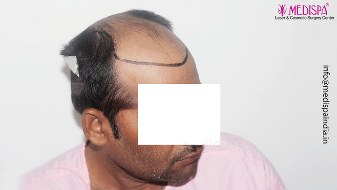 Dr. Suneet Soni - 4992 Grafts | 12-Month Result | Combination FUT + FUE + Beard photo