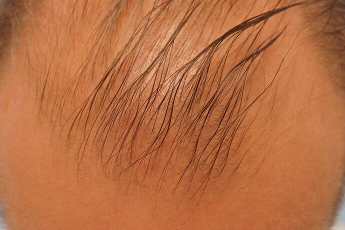 Dr B Farjo 1700g FUE (Front) photo