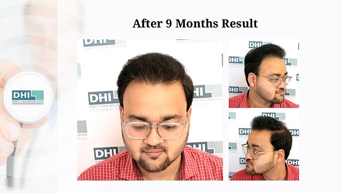 DHI India | NW Scale 5 | 2,923 Grafts | 9-Months DHI Hair Transplant Results photo