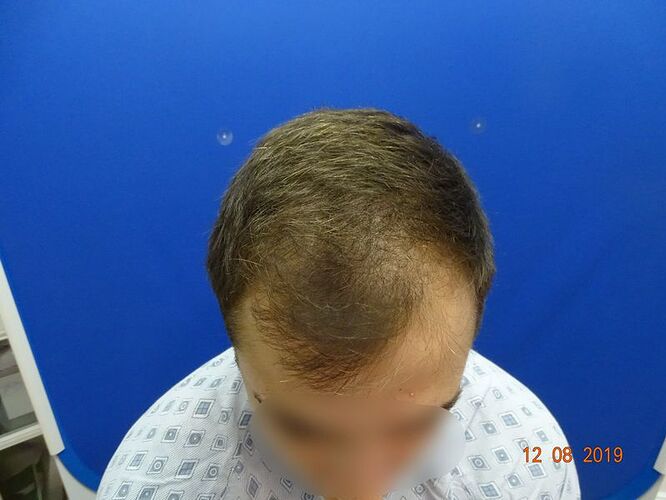 Dr.Bisanga, BHR Clinic - 3079 FUE 0 - 12 Months photo