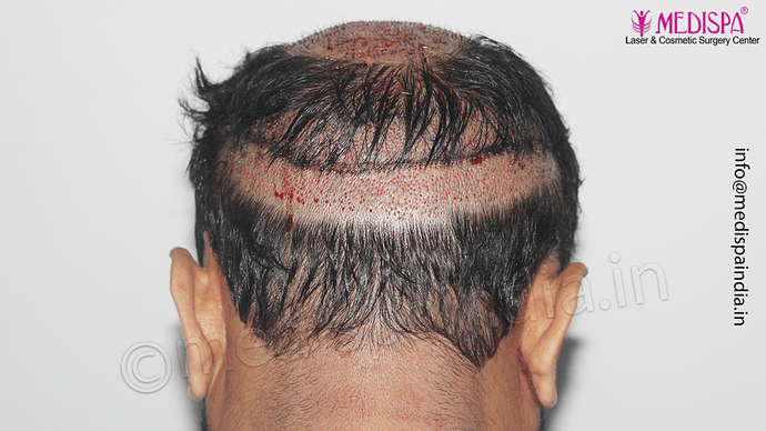 Dr. Suneet Soni - 5334 Grafts, Combine FUT + FUE + BHT (Beard) Technique, NW- V photo