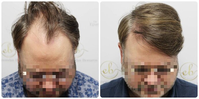 Dr Bonaros, Glasgow, UK / 3207 FUE grafts / 0-12 Months photo