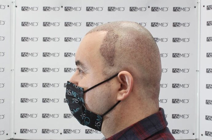 ASMED CLINIC - DR.KORAY - 5060 GRAFTS FUE photo