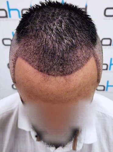 DR HAKAN DOGANAY/ 2000 GRAFTS / Implanter Pen+FUE photo