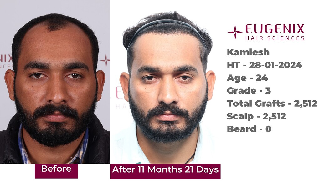 https://cdn.forumhairtransplant.com/optimized/3X/2/c/2ccd7881f82e5a4cb0f14c6b4d295e85c1be2a70_2_1035x582.jpeg