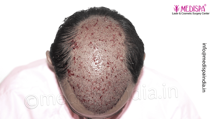 Dr. Suneet Soni - 4533 Grafts, Combine FUT + FUE Technique , NW-IV/V photo