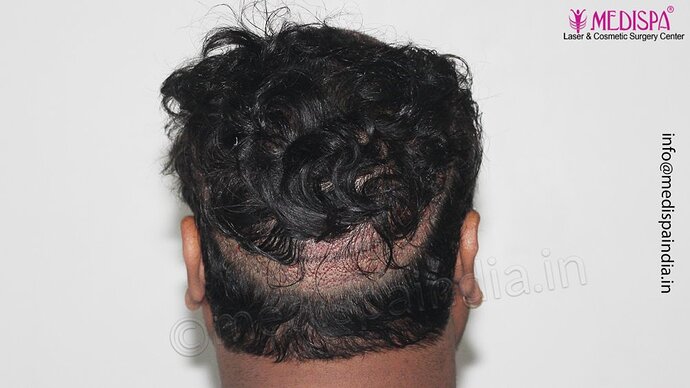 Dr. Suneet Soni - 4500 Grafts, 3 Year Result, NW-IV, Combine FUT + FUE Technique photo