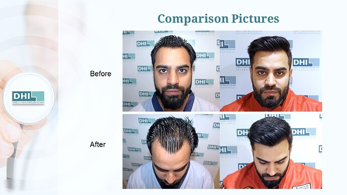 DHI India™ | NW 3 | 1,524 Grafts | Youthful Hairline Restored | DHI Hair Transplant photo