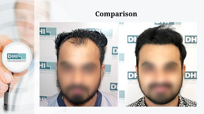 DHI India | Hair Line Reconstruction | Grade 3 | 2,088 Grafts | 10 Months Hair Transplant Results photo