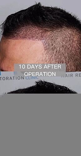 DR HAKAN DOGANAY/ Implanter Pen+FUE photo