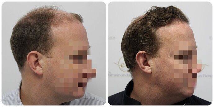 Dr Bonaros, Glasgow, UK / 4013 FUE grafts / 0-12 Months photo