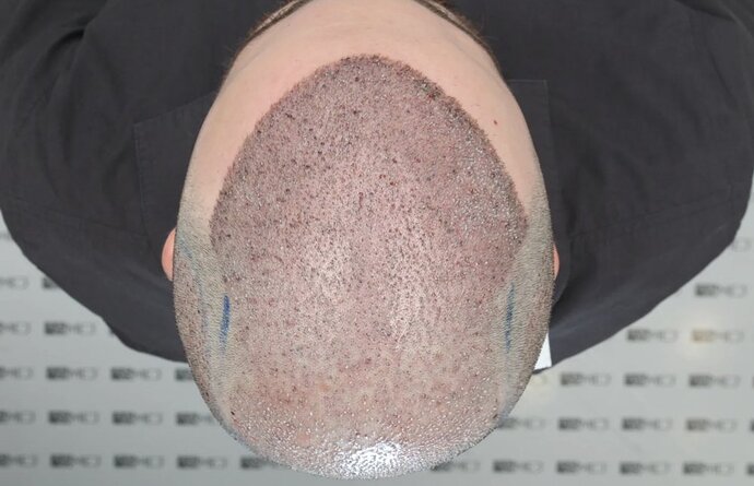 ASMED CLINIC CASE - DR.KORAY 5000 GRAFTS FUE photo