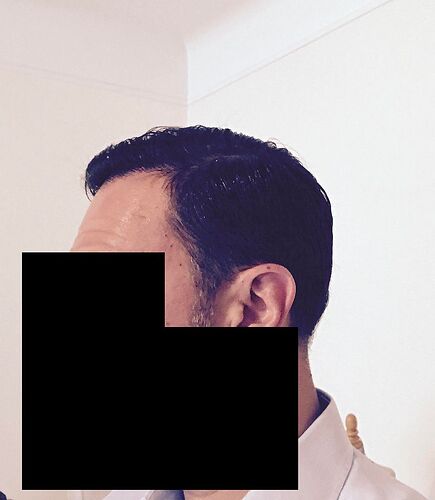 DR HAKAN DOGANAY/4055 GRAFTS/FUE+Implanter Pen photo