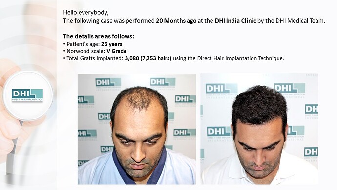 DHI India | NW 5 | 3,080 Grafts | 20-Months DHI Hair Transplant Results photo