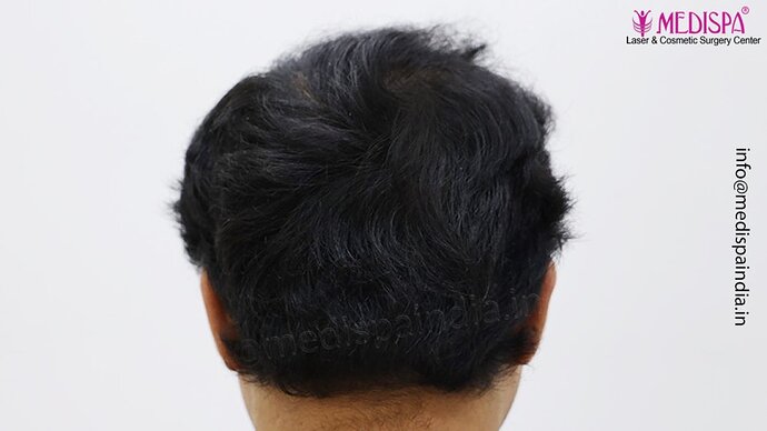 Dr. Suneet Soni - 5000 Grafts, Combine FUT + FUE + Beard Technique, NW-V photo