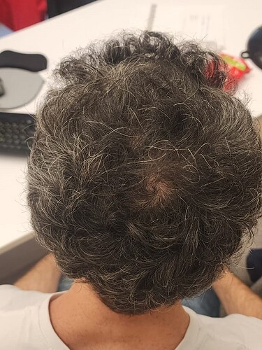 Result of Class 3V Patient – 3530 Grafts – HDC Hair clinic – Dr Maras photo