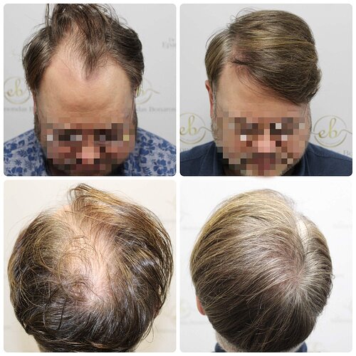 Dr Bonaros, Glasgow, UK / 3207 FUE grafts / 0-12 Months photo