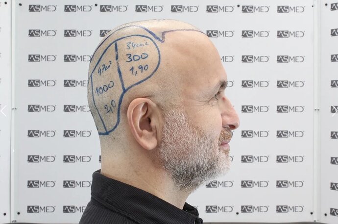 Asmed Clinic - FUE Hair Transplant - 5041 Grafts photo