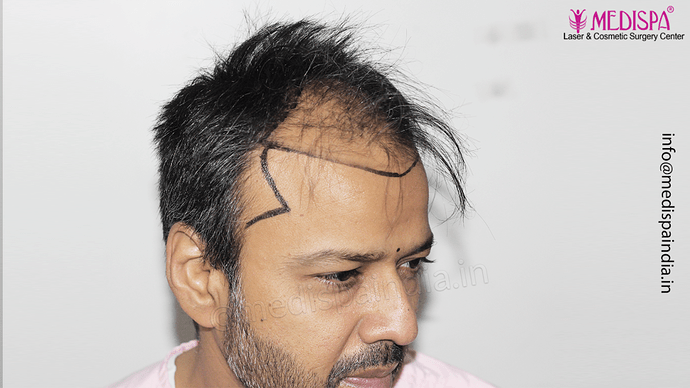 Dr. Suneet Soni - 4889 Grafts | 2.5 Years Result | Combination FUT + FUE + Beard photo