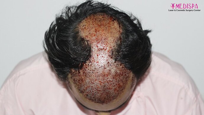 Dr. Suneet Soni - 4937 Grafts, Combine FUT + FUE Technique, NW : IV-V photo